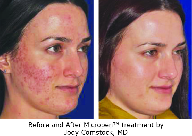 Eclipse Microneedling Before and After Photo on Acne