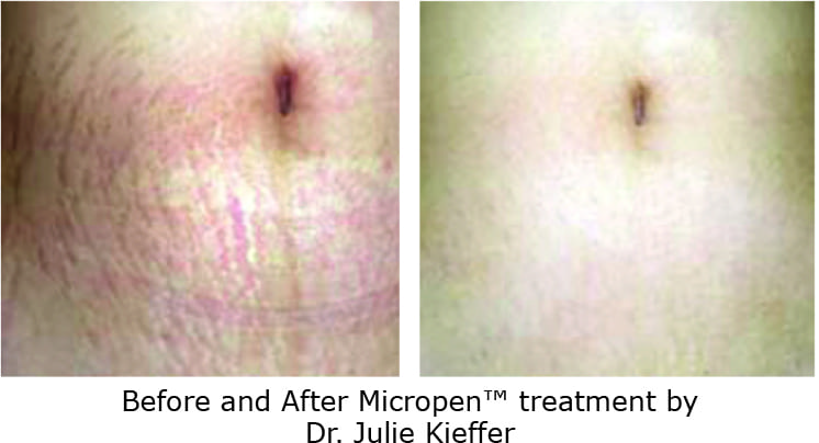 Eclipse Microneedling Before and After Photo on Stretchmarks