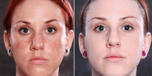 IPL Before and After Photo Facial Redness on Female Patient