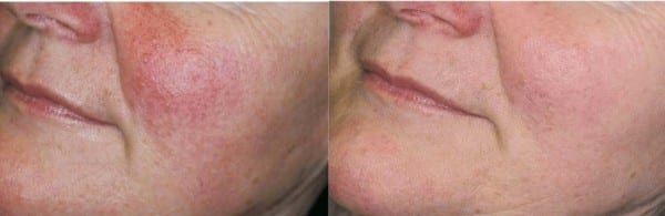 IPL Before and After Photos on Female Patients Red Cheeks