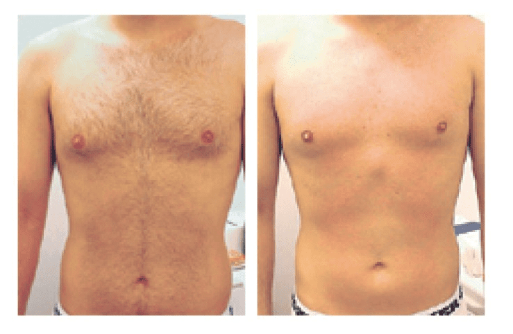 Laser Hair Removal Before and After of Male Patient's Torso