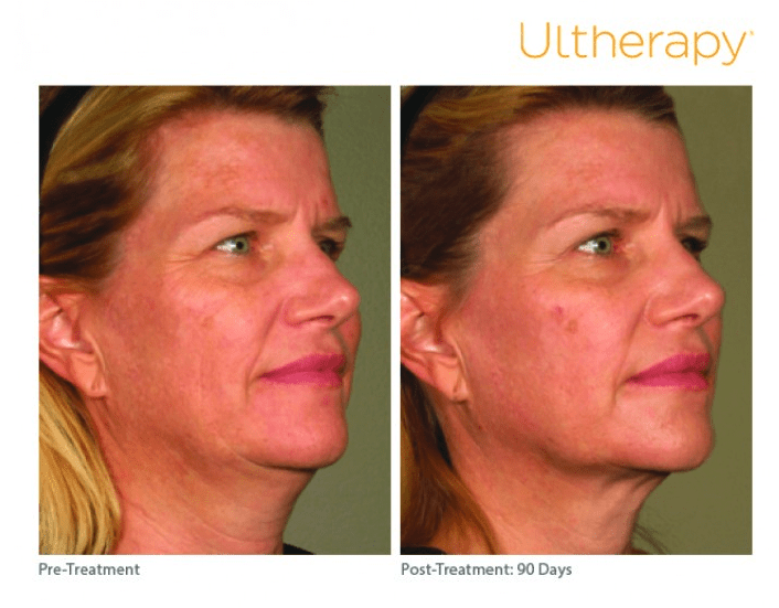 Ultherapy Before and After Photo of Female Patient