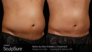 Sculpsure Fat Removal Before After Photo of Male Patient