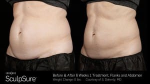 Sculpsure Before and After Photo of Female Torso