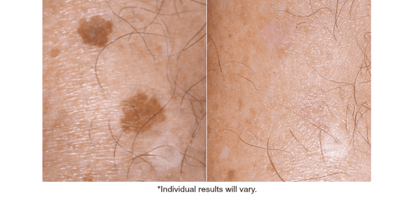 IPL Before and After Results on Sun Spots