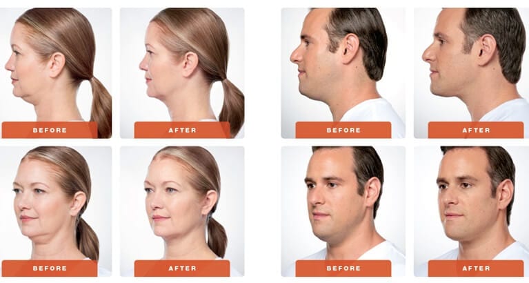 Kybella Before and After Results of Male and Female Patients