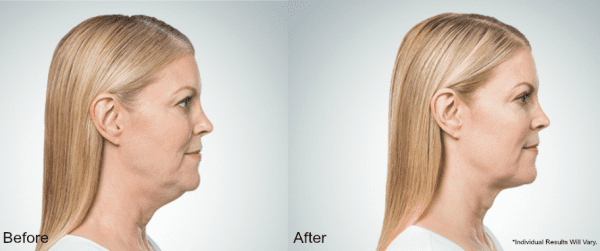 Kybella Before and After Results of Female Patient Profile Shot