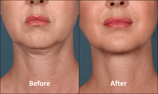 Kybella Before and After Results Lower Face Shot