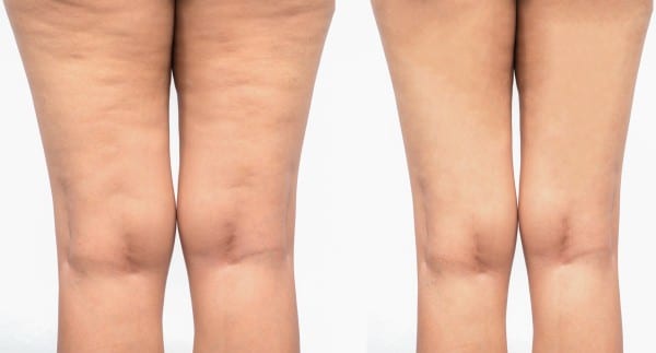 Tempsure Envi Before and After Photo of the Back of the Legs