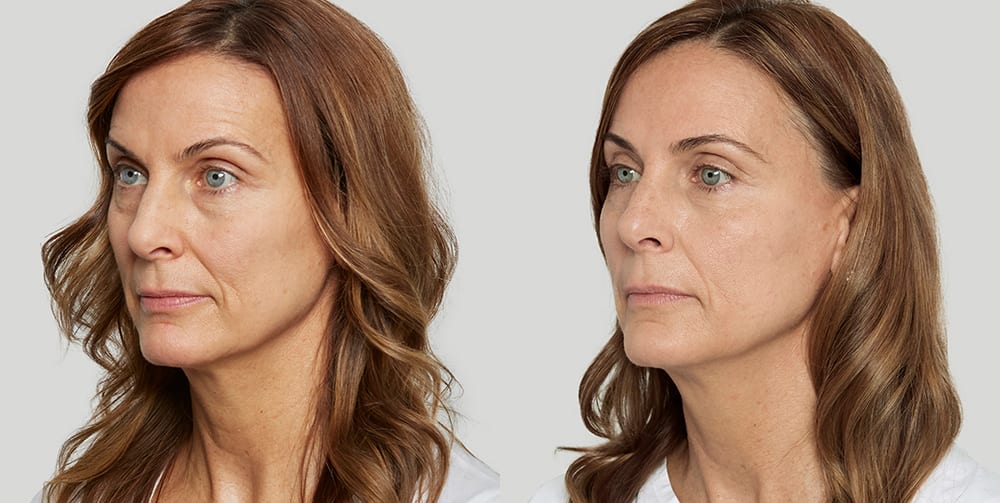 Sculptra Before and After Photo of Female Patient